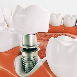 Dental implant in Los Angeles