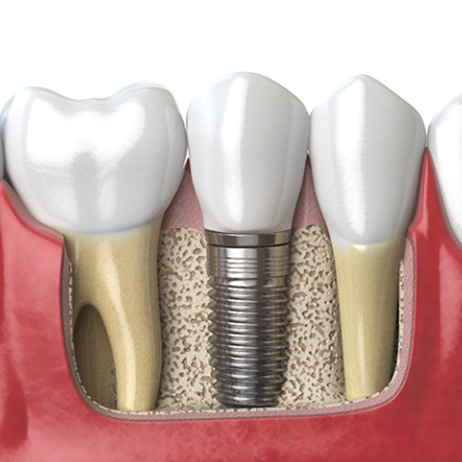 Traditional dental implant and crown between natural teeth