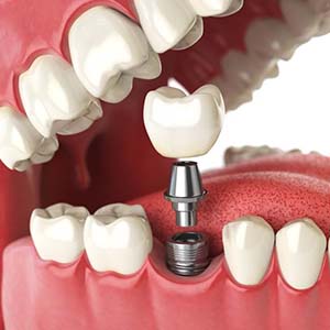 Dental implant in Los Angeles